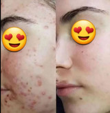 کرم آنتی آکنه ضدجوش و ضد لک
