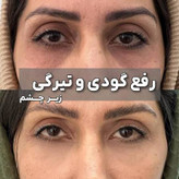 کرم دور چشم لاکچری کوین